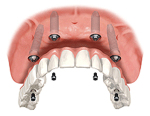 ایمپلنت جدید دندان