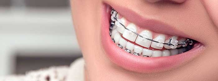 براکت‌های سرامیکی